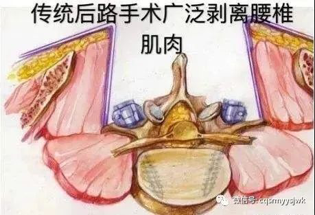 微创olif 巧 治腰椎病 院内新闻 新闻动态 重庆市璧山区人民医院