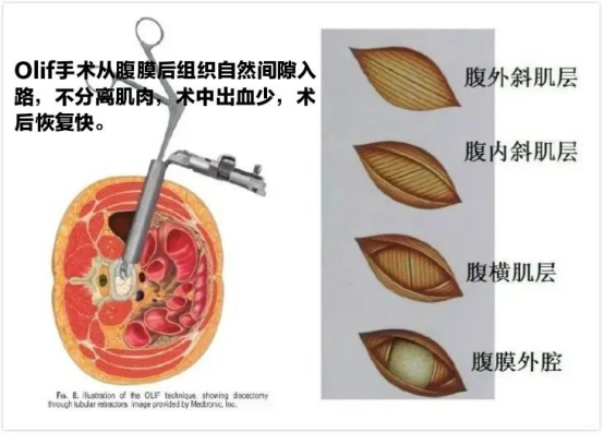 微创olif 巧 治腰椎病 院内新闻 新闻动态 重庆市璧山区人民医院